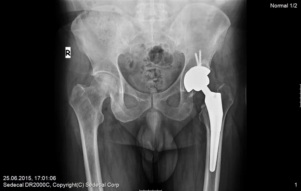 M_PELVIS_20160121_183712