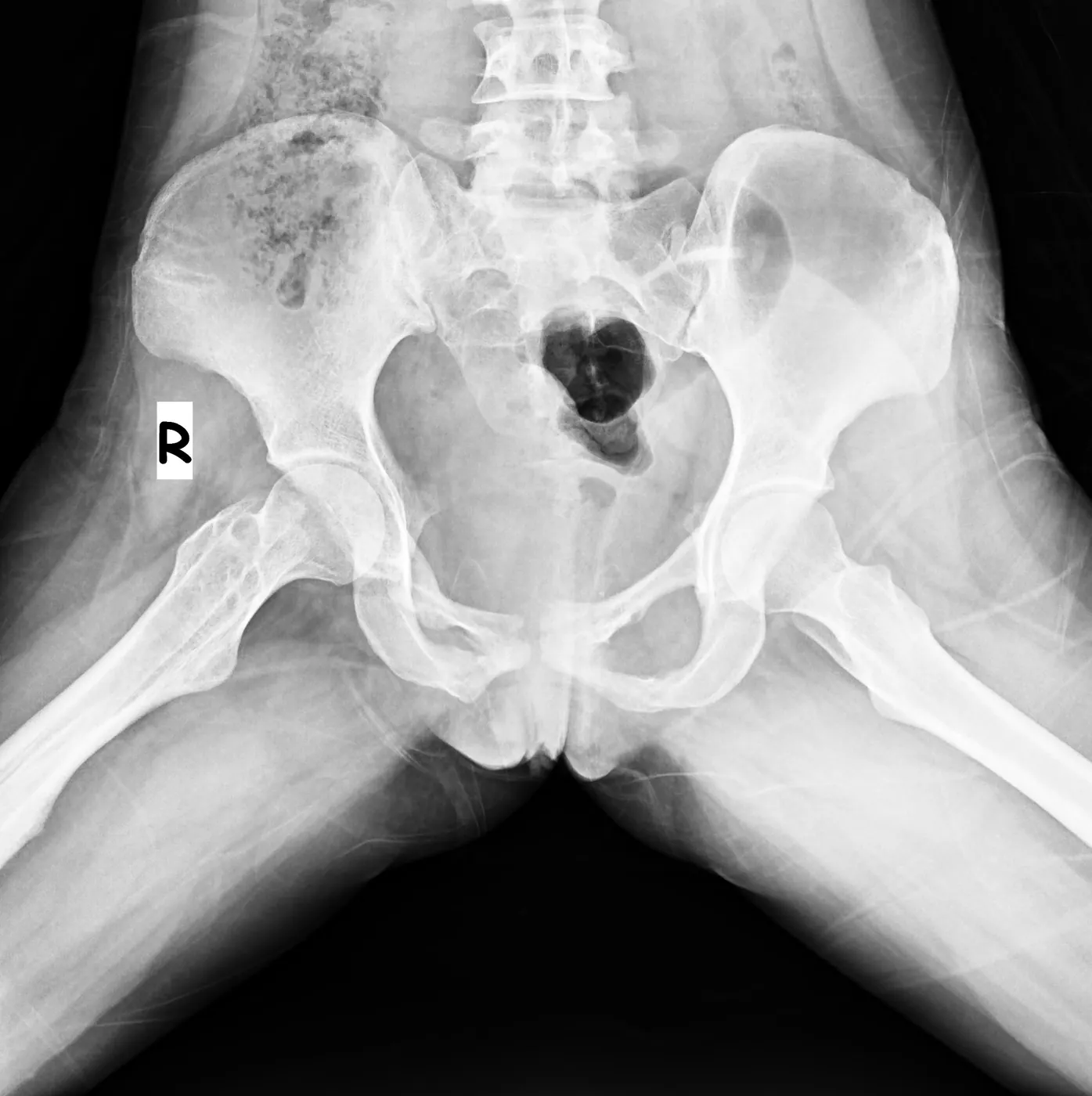implant çıkarımı sonrası 2