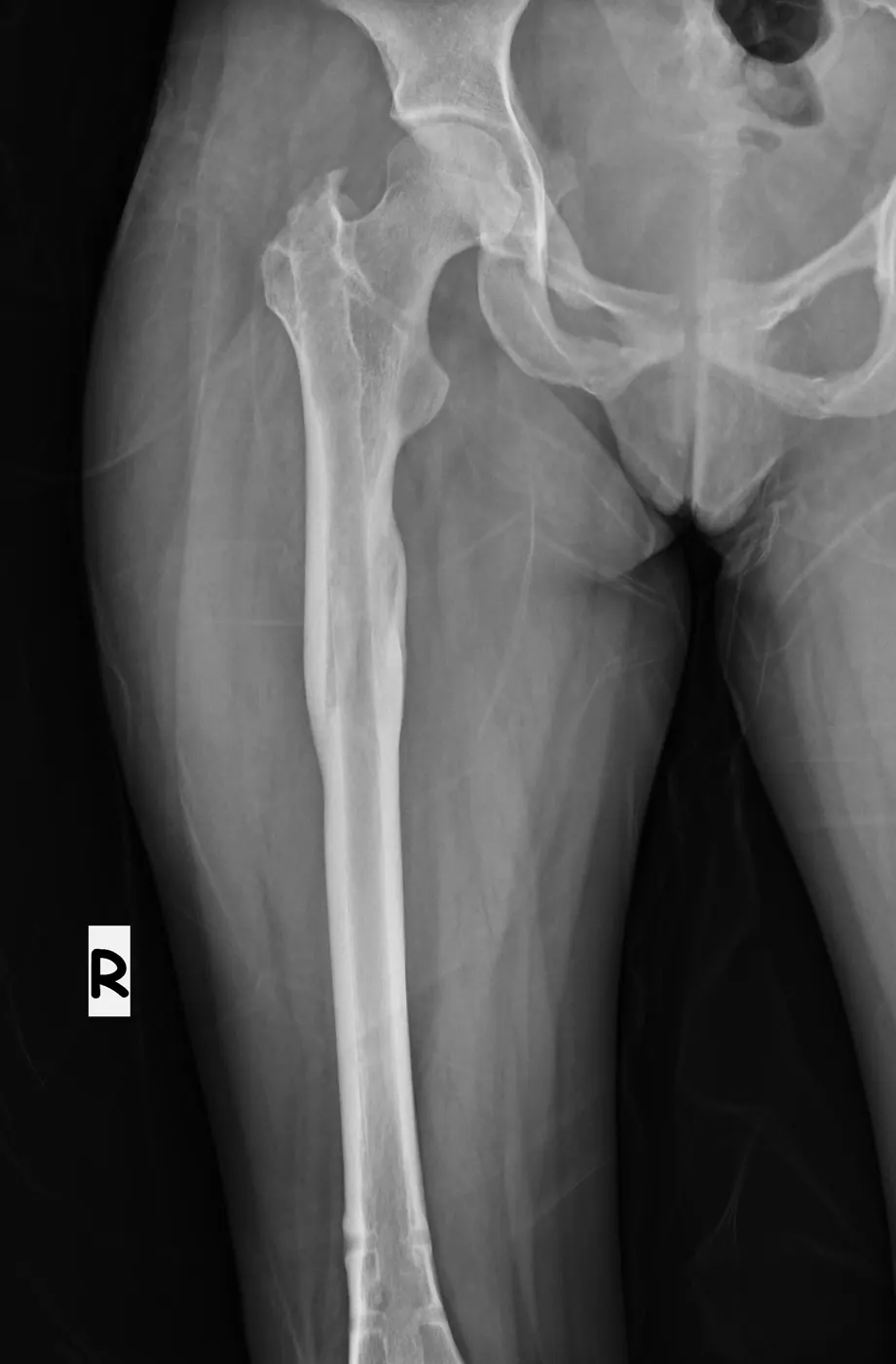 implant çıkarımı sonrası 3