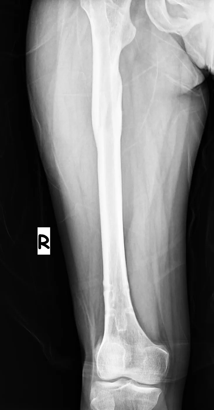 implant çıkarımı sonrası 4
