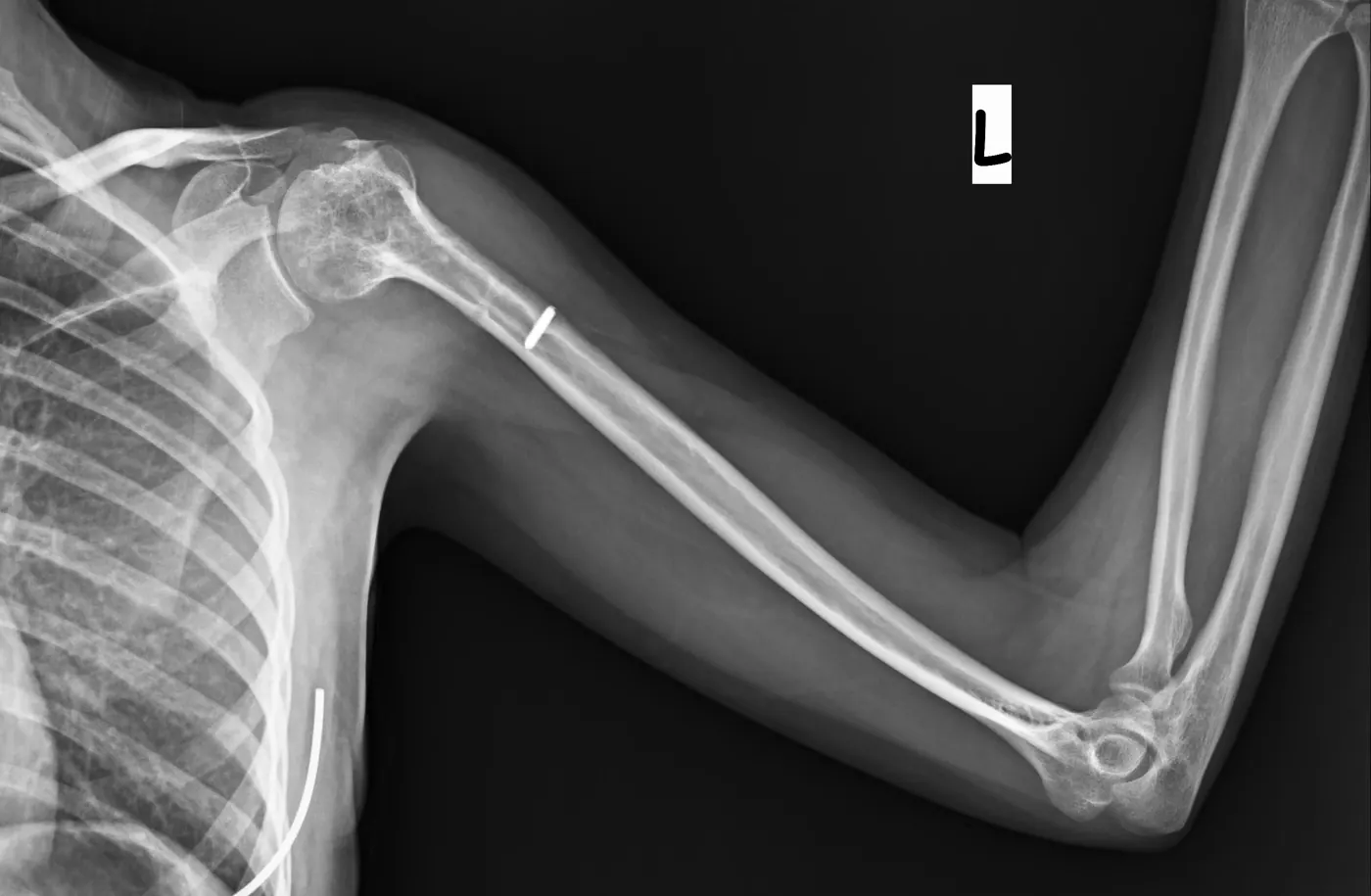 implant çıkarımı sonrası 5