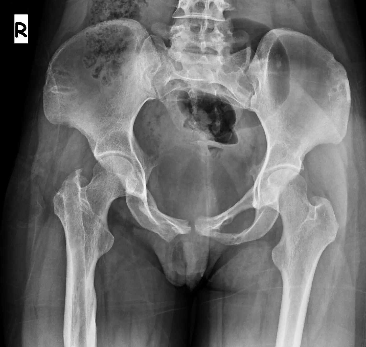implant çıkarımı sonrası1