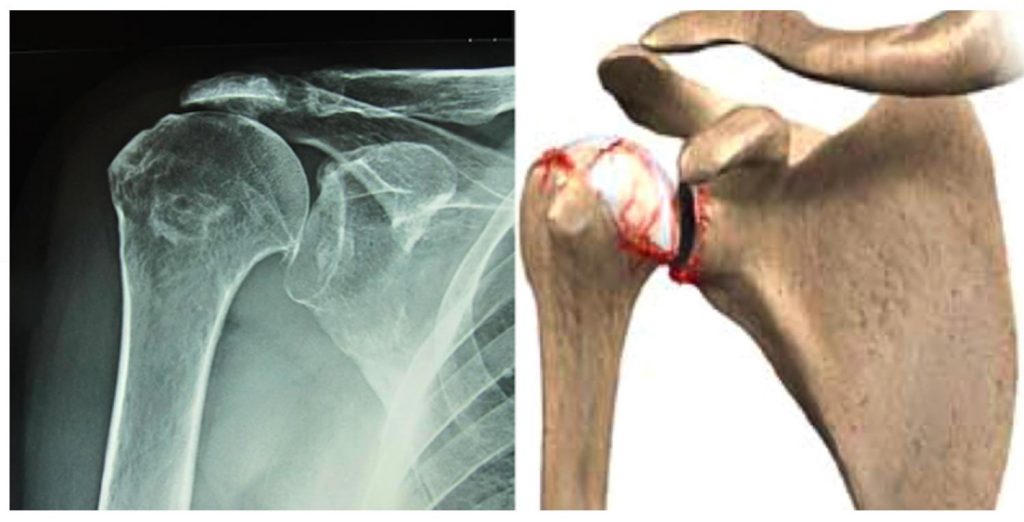 SHOULDER ARTHRITIS Prof. Dr. Levent Altınel Antalya, ortopedi