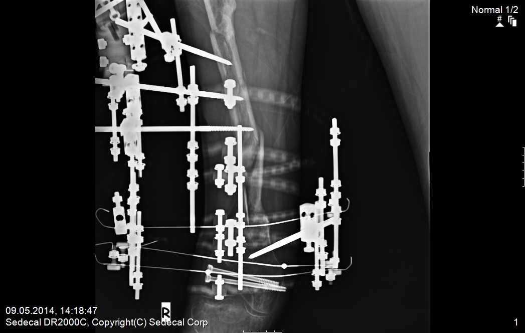 Uyluk kemiği (femur) kırığı defektli parçalı uyluk kemiği (femur) kığı Prof. Dr. Levent