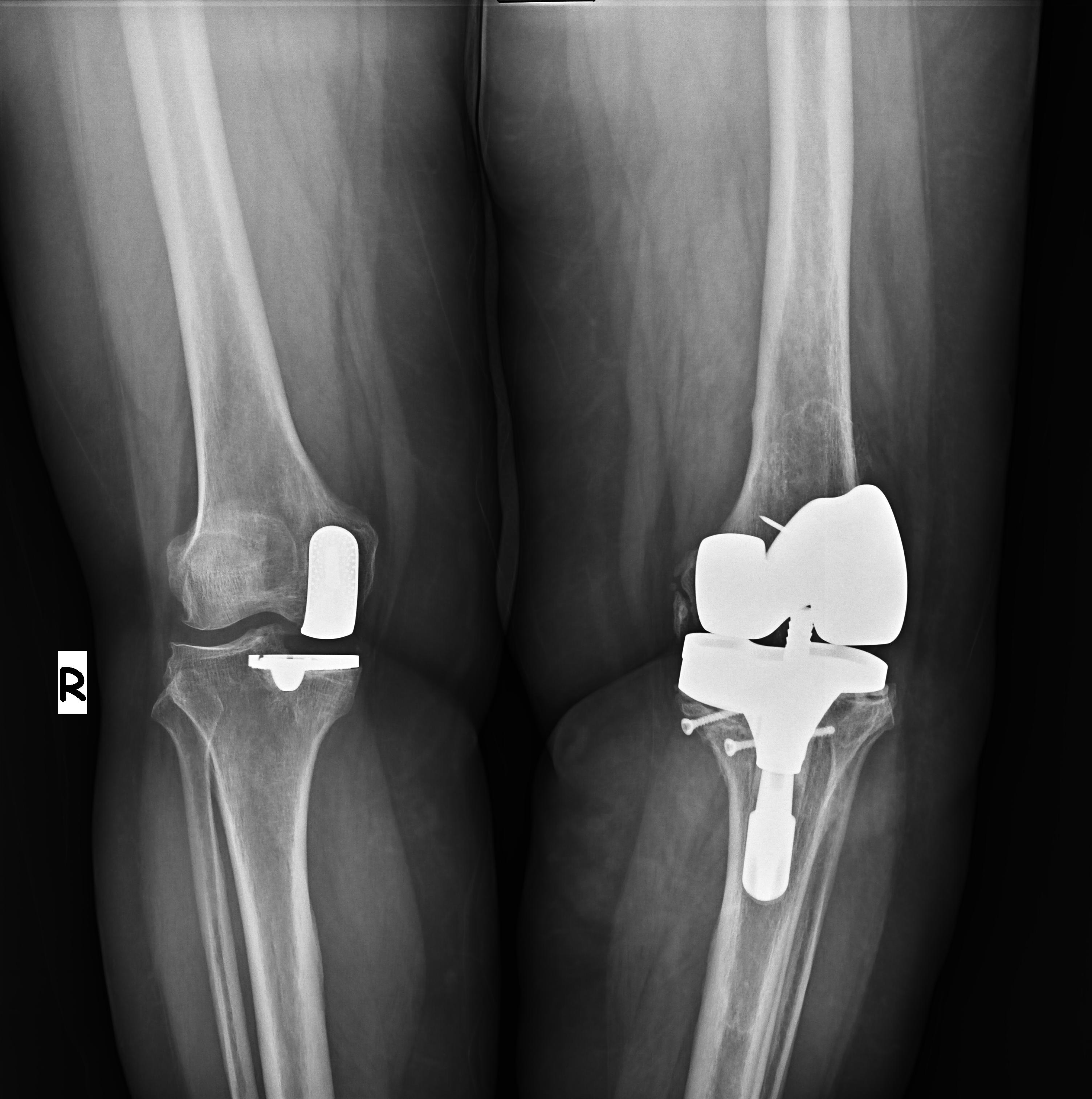ameliyat öncesi (sol diz 3. protez, sağ ilk kısmi protez)