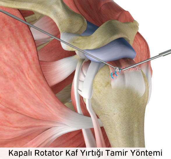 omuz tendon yirtiklarinin artroskopik tamiri prof dr levent altinel antalya ortopedi doktoru meniskus on capraz bag diz protezi kalca protezi ortopedi ve travmatoloji ortopedi uzmani ortopedi cerrahisi kireclenme omuz artoskopisi