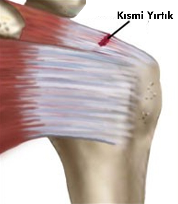 omuz tendon yirtiklarinin artroskopik tamiri prof dr levent altinel antalya ortopedi doktoru meniskus on capraz bag diz protezi kalca protezi ortopedi ve travmatoloji ortopedi uzmani ortopedi cerrahisi kireclenme omuz artoskopisi