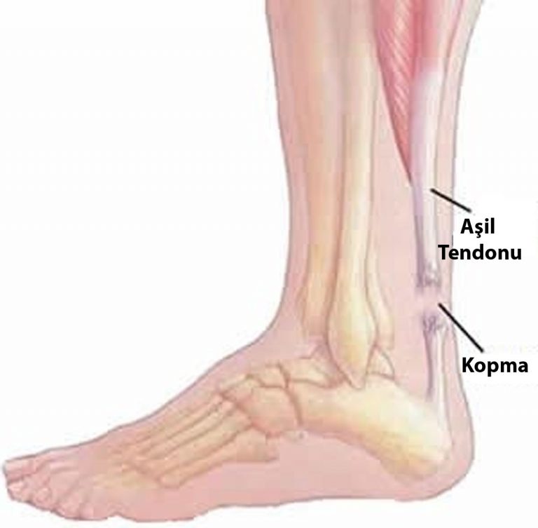 ахилл сухожилие. разрыв аххилесова сухожилия. ахиллово сухожилие разрыв.
