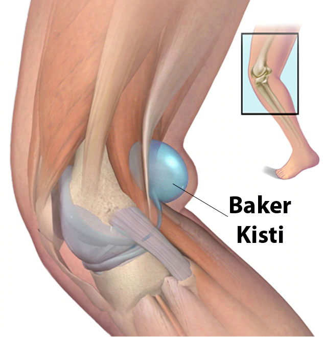 baker kisti nedir prof dr levent altinel antalya ortopedi doktoru meniskus on capraz bag diz protezi kalca protezi ortopedi ve travmatoloji ortopedi uzmani ortopedi cerrahisi kireclenme omuz artoskopisi kirik tedavisi