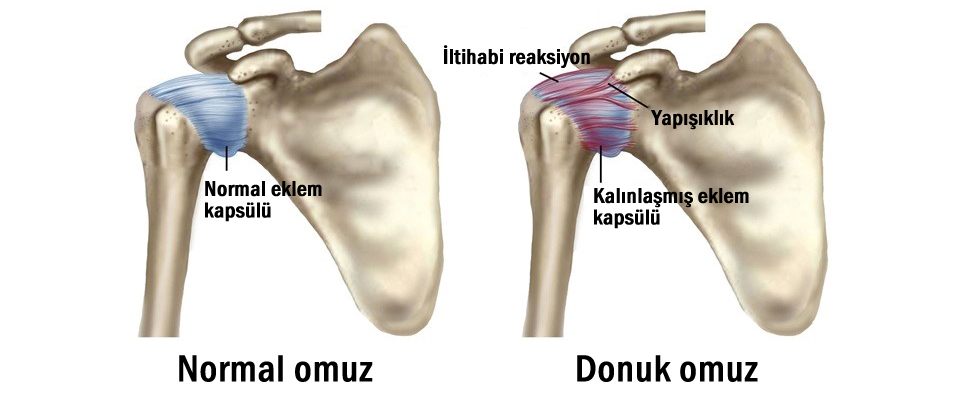 DONUK / DONMUŞ OMUZ SENDROMU NEDİR