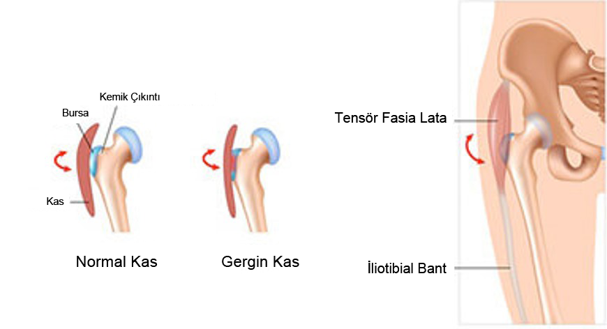 Snapping Hip / Atlayan Kalça Sendromu Nedir? – Prof. Dr. Levent Altınel   Antalya, ortopedi doktoru, menisküs, ön çapraz bağ, diz protezi, kalça  protezi, ortopedi ve travmatoloji, ortopedi uzmanı, ortopedi cerrahisi,  kireçlenme